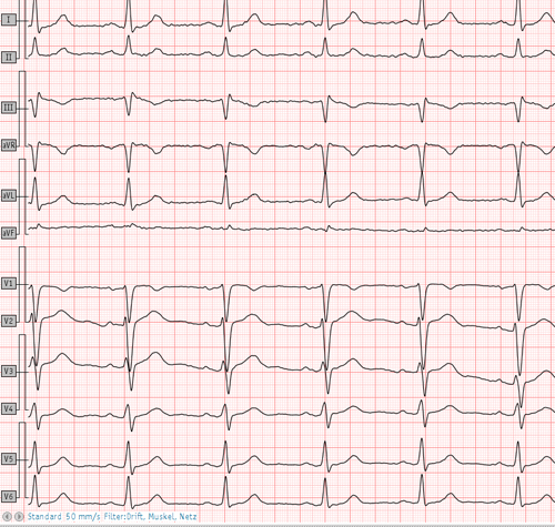 EKG